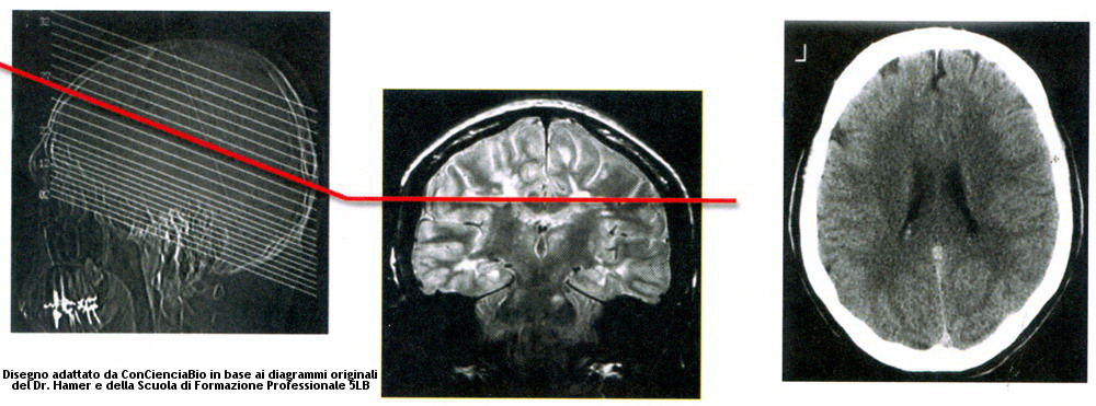Ectodermo corteccia Cerebral Nueva Medicina Germanica Hamer 3ra Ley Biologica Sistema Ontogenetico